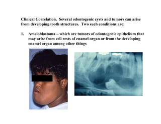 Clinical Correlation. Several odontogenic cysts and tumors can arise
from developing tooth structures. Two such conditions are:

1.   Ameloblastoma – which are tumors of odontogenic epithelium that
     may arise from cell rests of enamel organ or from the developing
     enamel organ among other things
 