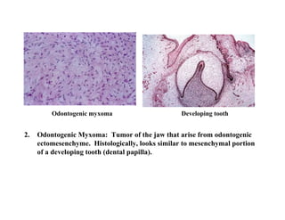 Odontogenic myxoma                       Developing tooth


2.   Odontogenic Myxoma: Tumor of the jaw that arise from odontogenic
     ectomesenchyme. Histologically, looks similar to mesenchymal portion
     of a developing tooth (dental papilla).
 