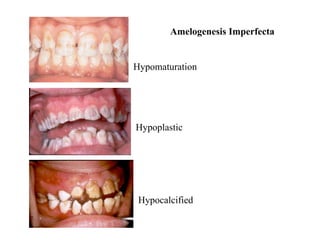 Amelogenesis Imperfecta


Hypomaturation




Hypoplastic




 Hypocalcified
 