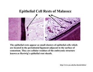 Epithelial Cell Rests of Malassez




The epithelial rests appear as small clusters of epithelial cells which
are located in the periodontal ligament adjacent to the surface of
cementum. They are cellular residues of the embryonic structure
known as Hertwig's epithelial root sheath.



                                                    http://www.usc.edu/hsc/dental/ohisto/
 