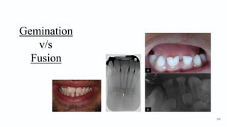 Gemination
v/s
Fusion
100
 