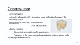 Concrescence1
• Growing together.
• Union of 2 adjacent teeth by cementum alone without confluence of the
underlying dentin.
• Pathogenesis: It could be – developmental
post-inflammatory.
• Clinical Features:
Diagnosis is upon radiographic examination.
Frequently in the posterior maxillary region involving a second molar
and an impacted third molar.
101
 