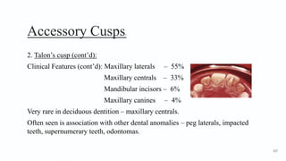 Accessory Cusps5
2. Talon’s cusp (cont’d):
Clinical Features (cont’d): Maxillary laterals – 55%
Maxillary centrals – 33%
Mandibular incisors – 6%
Maxillary canines – 4%
Very rare in deciduous dentition – maxillary centrals.
Often seen is association with other dental anomalies – peg laterals, impacted
teeth, supernumerary teeth, odontomas.
107
 