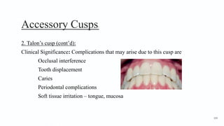 Accessory Cusps7
2. Talon’s cusp (cont’d):
Clinical Significance: Complications that may arise due to this cusp are
Occlusal interference
Tooth displacement
Caries
Periodontal complications
Soft tissue irritation – tongue, mucosa
109
 