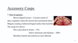 Accessory Cusps10
3. Dens Evaginatus:
Shovel-shaped incisors – Coronal variant of
dens evaginatus where the incisors have prominent lateral
Margins creating a hollowed lingual surface that resembles
The scoop of a shovel.
This is prevalent in Asians – 15%
Native Americans and Alaskans – 100%
Maxillary laterals and centrals are most affected.
112
 