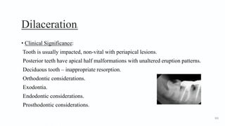 Dilaceration3
• Clinical Significance:
Tooth is usually impacted, non-vital with periapical lesions.
Posterior teeth have apical half malformations with unaltered eruption patterns.
Deciduous tooth – inappropriate resorption.
Orthodontic considerations.
Exodontia.
Endodontic considerations.
Prosthodontic considerations.
121
 