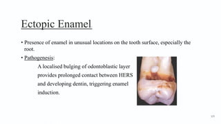 Ectopic Enamel1
• Presence of enamel in unusual locations on the tooth surface, especially the
root.
• Pathogenesis:
A localised bulging of odontoblastic layer
provides prolonged contact between HERS
and developing dentin, triggering enamel
induction.
125
 