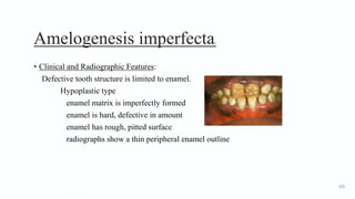 Amelogenesis imperfecta3
• Clinical and Radiographic Features:
Defective tooth structure is limited to enamel.
Hypoplastic type
enamel matrix is imperfectly formed
enamel is hard, defective in amount
enamel has rough, pitted surface
radiographs show a thin peripheral enamel outline
131
 