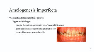 Amelogenesis imperfecta4
• Clinical and Radiographic Features:
Hypocalcified type
matrix formation appears to be of normal thickness
calcification is deficient and enamel is soft
enamel becomes stained easily
132
 