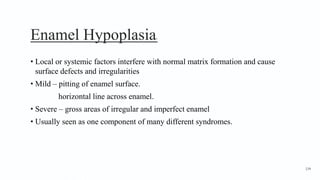 Enamel Hypoplasia1
• Local or systemic factors interfere with normal matrix formation and cause
surface defects and irregularities
• Mild – pitting of enamel surface.
horizontal line across enamel.
• Severe – gross areas of irregular and imperfect enamel
• Usually seen as one component of many different syndromes.
134
 