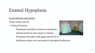 Enamel Hypoplasia12
Local infection and trauma:
Turner tooth (cont’d)
• Clinical Features:
Permanent maxillary incisors as deciduous
anterior teeth are more prone to trauma.
Permanent bicuspid, both upper and lower as
deciduous molars are more prone to periapical infections.
145
 