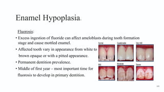 Enamel Hypoplasia16
Fluorosis:
• Excess ingestion of fluoride can affect ameloblasts during tooth formation
stage and cause mottled enamel.
• Affected tooth vary in appearance from white to
brown opaque or with a pitted appearance.
• Permanent dentition prevalence.
• Middle of first year – most important time for
fluorosis to develop in primary dentition.
149
 