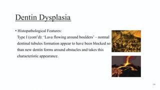 Dentin Dysplasia7
• Histopathological Features:
Type I (cont’d): ‘Lava flowing around boulders’ – normal
dentinal tubules formation appear to have been blocked so
than new dentin forms around obstacles and takes this
characteristic appearance.
156
 