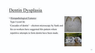 Dentin Dysplasia8
• Histopathological Features:
Type I (cont’d):
‘Cascades of dentin’ – electron microscopy by Sank and
his co-workers have suggested this pattern where
repetitive attempts to form dentin have been made.
157
 