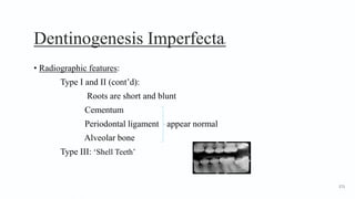 Dentinogenesis Imperfecta6
• Radiographic features:
Type I and II (cont’d):
Roots are short and blunt
Cementum
Periodontal ligament appear normal
Alveolar bone
Type III: ‘Shell Teeth’
171
 