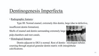 Dentinogenesis Imperfecta7
• Radiographic features:
Type III: Normal enamel, extremely thin dentin, large (due to defective,
insufficient dentin formation).
Shells of enamel and dentin surrounding extremely large
pulp chambers and root canals.
• Histological features:
Dentin adjacent to DEJ is normal. Rest of dentin - misshapen tubules
coursing through atypical granular dentin matrix with interglobular
calcifications.
172
 