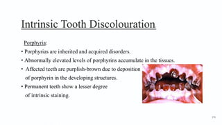 Intrinsic Tooth Discolouration3
Porphyria:
• Porphyrias are inherited and acquired disorders.
• Abnormally elevated levels of porphyrins accumulate in the tissues.
• Affected teeth are purplish-brown due to deposition
of porphyrin in the developing structures.
• Permanent teeth show a lesser degree
of intrinsic staining.
176
 
