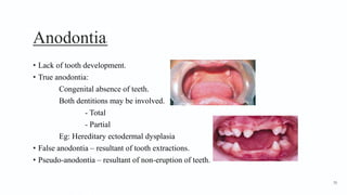 Anodontia1
• Lack of tooth development.
• True anodontia:
Congenital absence of teeth.
Both dentitions may be involved.
- Total
- Partial
Eg: Hereditary ectodermal dysplasia
• False anodontia – resultant of tooth extractions.
• Pseudo-anodontia – resultant of non-eruption of teeth.
70
 