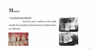 Microdontia2
• Localised microdontia:
Involves only 1 tooth or a few teeth,
usually the maxillary lateral incisor or third molars
are affected.
86
 