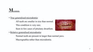 Microdontia3
• True generalised microdontia:
All teeth are smaller in size than normal.
This condition is very rare.
Seen in few cases of pituitary dwarfism.
• Relative generalised microdontia:
Normal teeth are present in larger than normal jaws.
Macrognathia rather than microdontia.
87
 