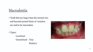 Macrodontia1
• Teeth that are larger than the normal size
and beyond normal limits of variation
are said to be macrodont.
• Types:
Localised
Generalised – True
Relative
90
 