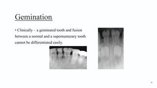 Gemination3
• Clinically – a geminated tooth and fusion
between a normal and a supernumerary tooth
cannot be differentiated easily.
96
 