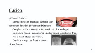 Fusion2
• Clinical Features:
More common in deciduous dentition than
permanent dentition. (Graham and Granath)
Complete fusion – contact before tooth calcification begins.
Incomplete fusion – contact after a part of crown formation is done.
Roots may be fused or separate.
Dentin is always confluent in cases
of true fusion.
98
 