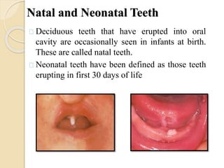 Natal and Neonatal Teeth
Deciduous teeth that have erupted into oral
cavity are occasionally seen in infants at birth.
These are called natal teeth.
Neonatal teeth have been defined as those teeth
erupting in first 30 days of life
 