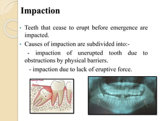 Impaction
• Teeth that cease to erupt before emergence are
impacted.
• Causes of impaction are subdivided into:-
- impaction of unerupted tooth due to
obstructions by physical barriers.
- impaction due to lack of eruptive force.
 