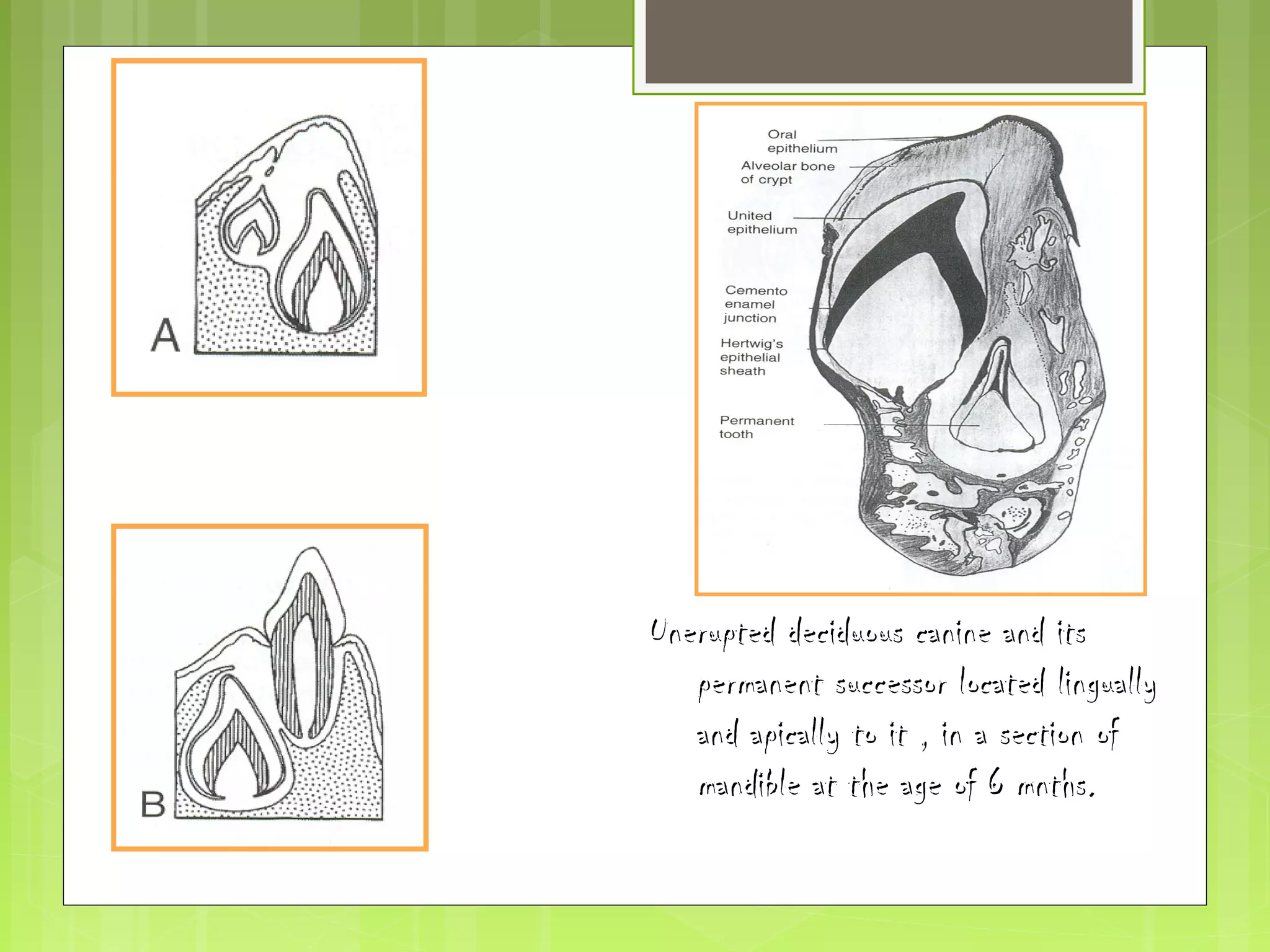Unerupted ddeecciidduuoouuss ccaanniinnee aanndd iittss 
ppeerrmmaanneenntt ssuucccceessssoorr llooccaatteedd lliinngguuaallllyy 
aanndd aappiiccaallllyy ttoo iitt ,, iinn aa sseeccttiioonn ooff 
mmaannddiibbllee aatt tthhee aaggee ooff 66 mmnntthhss.. 
 