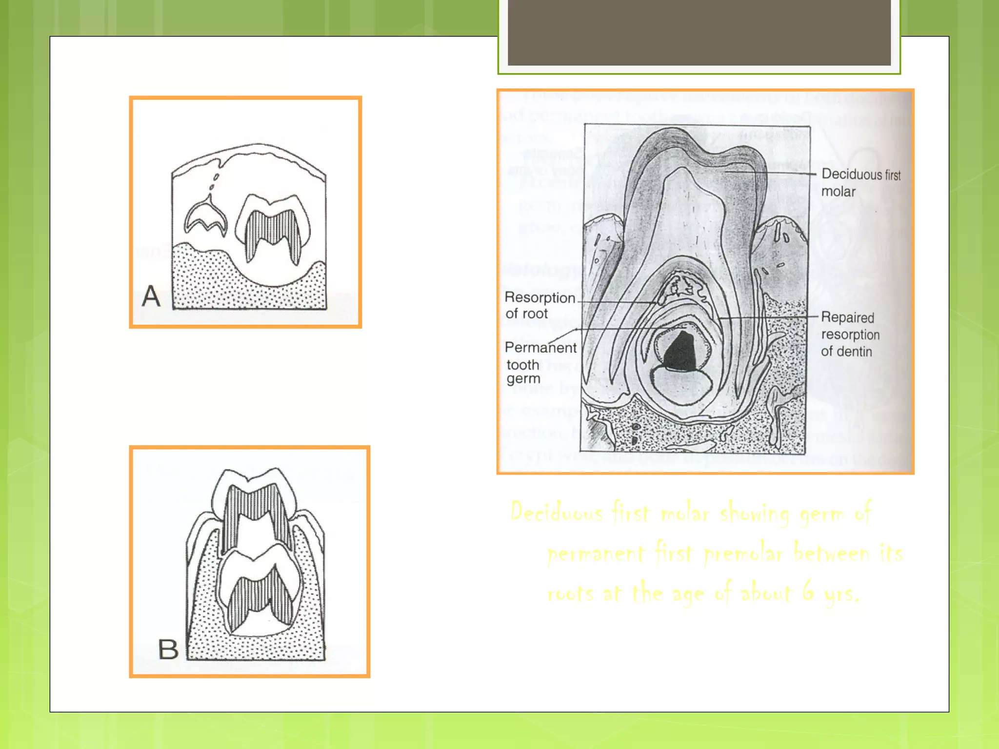 Deciduous first molar showing germ of 
permanent first premolar between its 
roots at the age of about 6 yrs. 
 