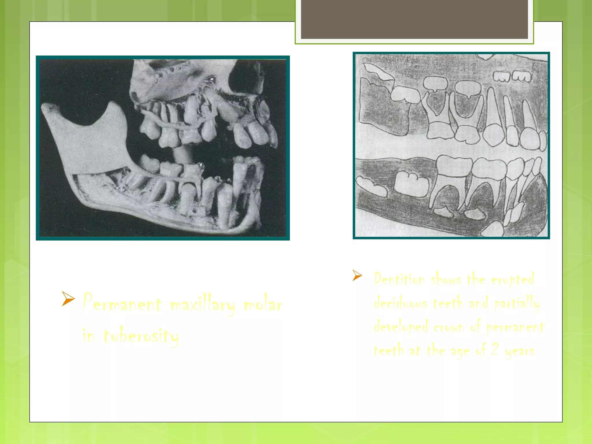  Permanent maxillary molar 
in tuberosity 
 Dentition shows the erupted 
deciduous teeth and partially 
developed crown of permanent 
teeth at the age of 2 years 
 