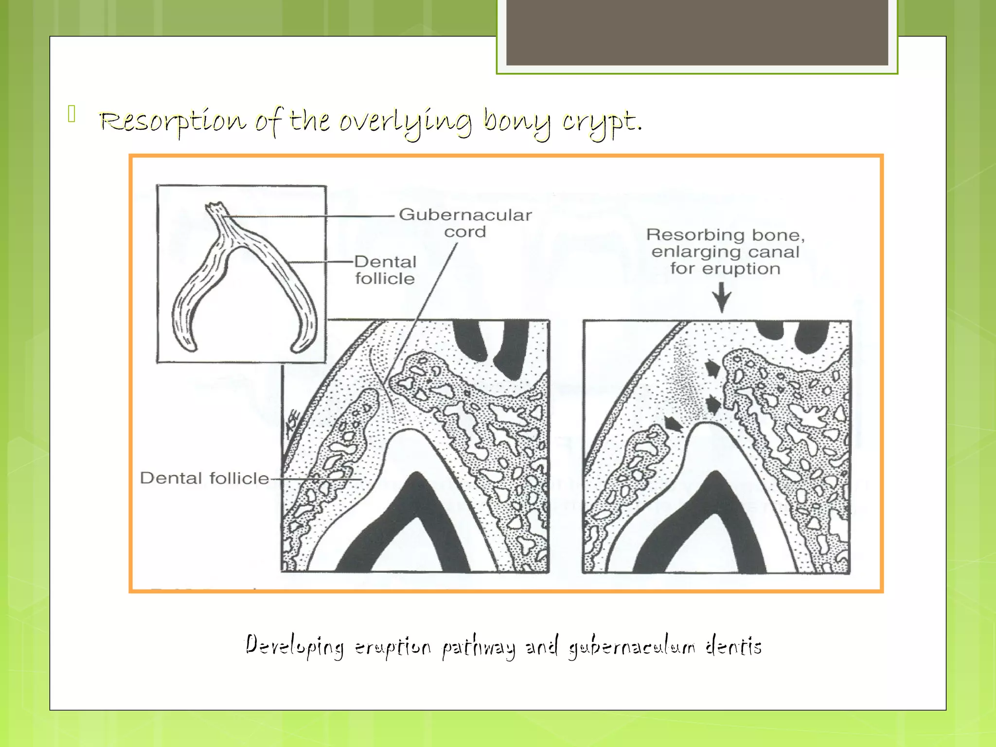  Resorption ooff tthhee oovveerrllyyiinngg bboonnyy ccrryypptt.. 
DDeevveellooppiinngg eerruuppttiioonn ppaatthhwwaayy aanndd gguubbeerrnnaaccuulluumm ddeennttiiss 
 
