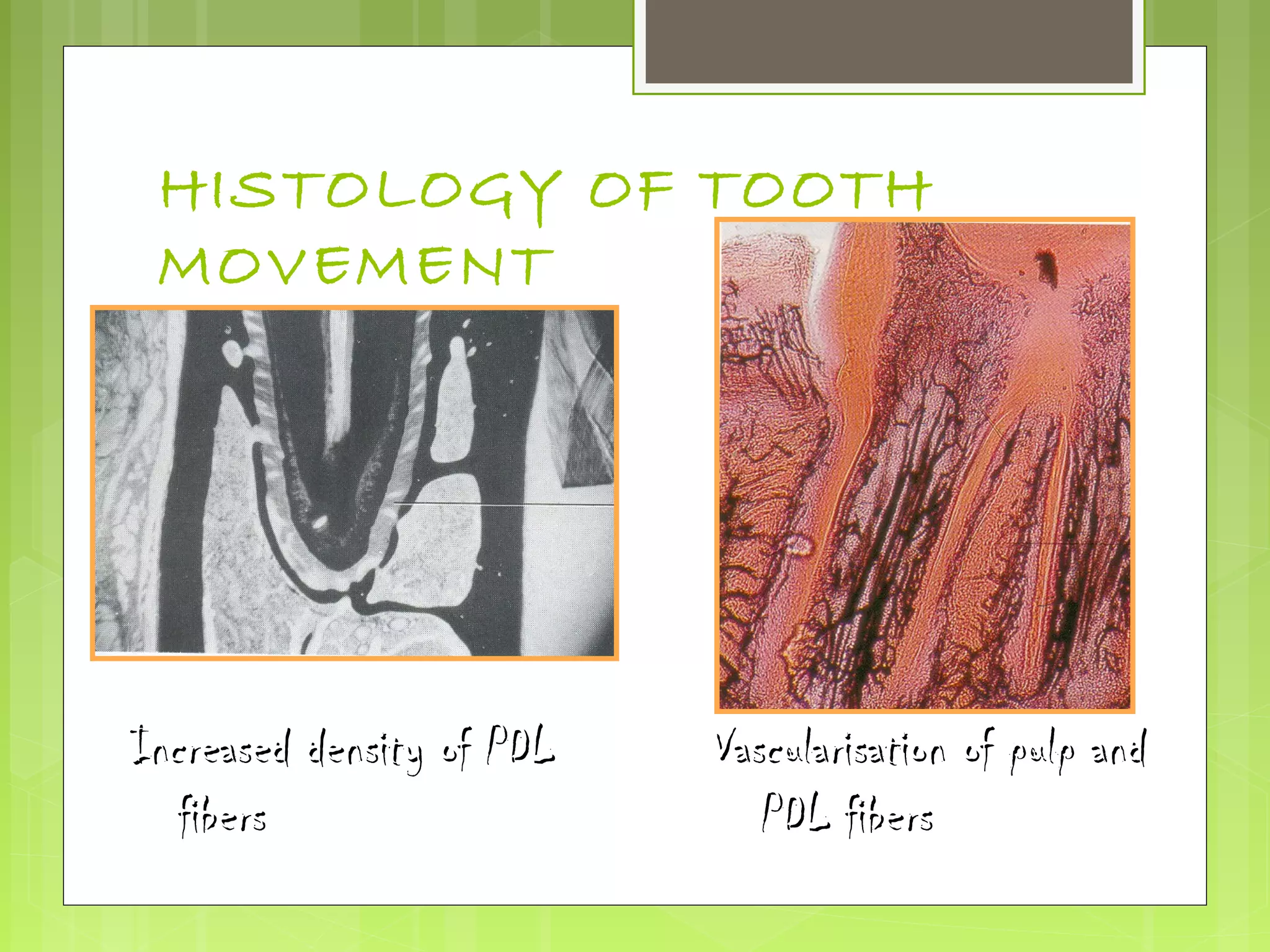 HISTOLOGY OF TOOTH 
MOVEMENT 
IInnccrreeaasseedd ddeennssiittyy ooff PPDDLL 
ffiibbeerrss 
VVaassccuullaarriissaattiioonn ooff ppuullpp aanndd 
PPDDLL ffiibbeerrss 
 