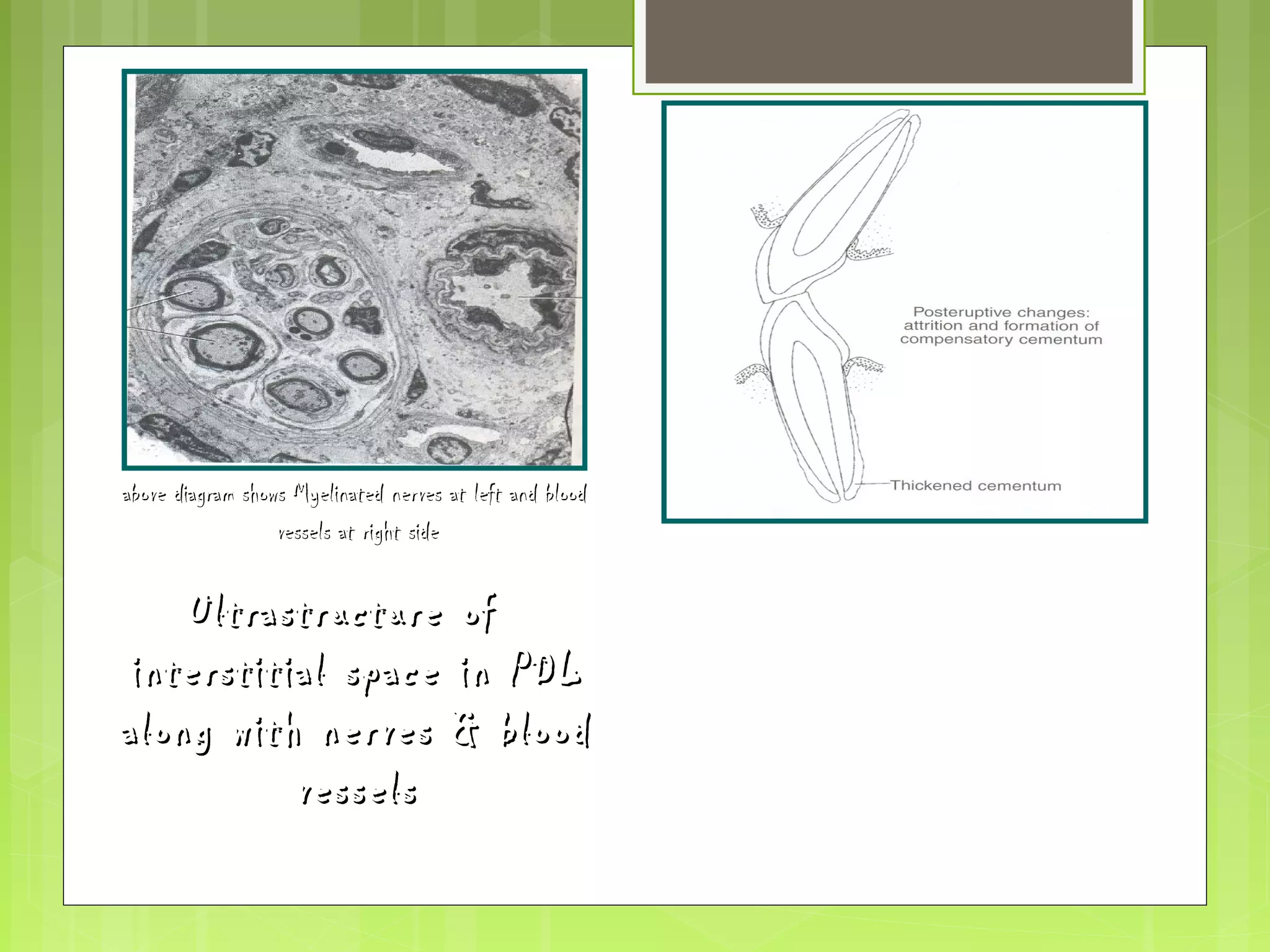 aabboovvee ddiiaaggrraamm sshhoowwss MMyyeelliinnaatteedd nneerrvveess aatt lleefftt aanndd bblloooodd 
vveesssseellss aatt rriigghhtt ssiiddee 
UUllttrraassttrruuccttuurree ooff 
iinntteerrssttiittiiaall ssppaaccee iinn PPDDLL 
aalloonngg wwiitthh nneerrvveess && bblloooodd 
vveesssseellss 
Posteruptive changes : attrition 
and compensative formation of 
cementum 
 