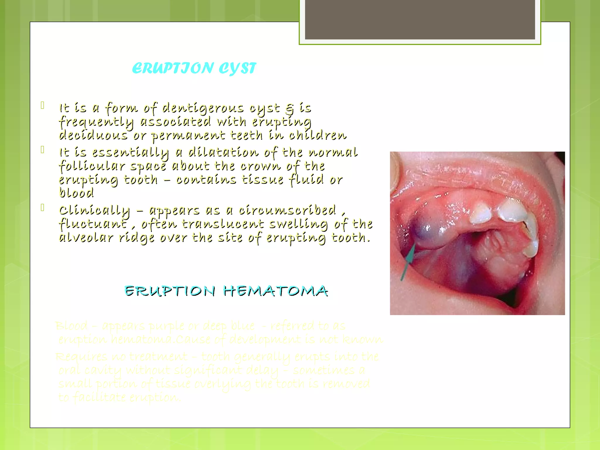 ERUPTION CYST 
 It is a form of dentigerous ccyysstt && iiss 
ffrreeqquueennttllyy aassssoocciiaatteedd wwiitthh eerruuppttiinngg 
ddeecciidduuoouuss oorr ppeerrmmaanneenntt tteeeetthh iinn cchhiillddrreenn 
 IItt iiss eesssseennttiiaallllyy aa ddiillaattaattiioonn ooff tthhee nnoorrmmaall 
ffoolllliiccuullaarr ssppaaccee aabboouutt tthhee ccrroowwnn ooff tthhee 
eerruuppttiinngg ttooootthh –– ccoonnttaaiinnss ttiissssuuee fflluuiidd oorr 
bblloooodd 
 CClliinniiccaallllyy –– aappppeeaarrss aass aa cciirrccuummssccrriibbeedd ,, 
fflluuccttuuaanntt ,, oofftteenn ttrraannsslluucceenntt sswweelllliinngg ooff tthhee 
aallvveeoollaarr rriiddggee oovveerr tthhee ssiittee ooff eerruuppttiinngg ttooootthh.. 
EERRUUPPTTIIOONN HHEEMMAATTOOMMAA 
Blood – appears purple or deep blue - referred to as 
eruption hematoma.Cause of development is not known 
Requires no treatment – tooth generally erupts into the 
oral cavity without significant delay – sometimes a 
small portion of tissue overlying the tooth is removed 
to facilitate eruption. 
 