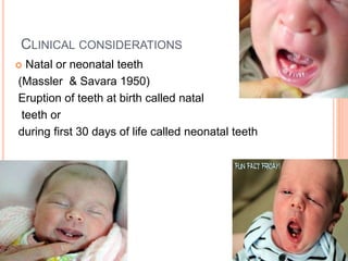 CLINICAL CONSIDERATIONS
 Natal or neonatal teeth
(Massler & Savara 1950)
Eruption of teeth at birth called natal
teeth or
during first 30 days of life called neonatal teeth
 