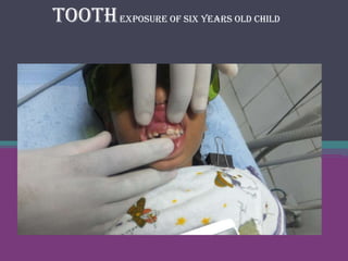Tooth exposure of six years old child
 