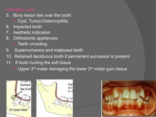 Tooth Extraction Ngoma.pdf