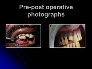 Pre-post operative
photographs
 
