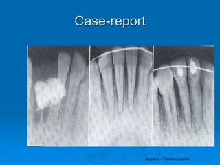 Tooth Microfracture Tooth Fracture Treatment | PPT
