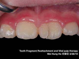 Tooth Fragment Reattachment and Vital pulp therapy 
Wei Hung He 何偉宏 3/26/19
 