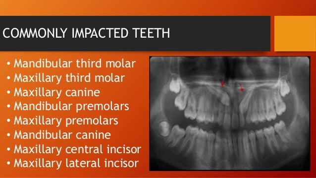 impacted tooth