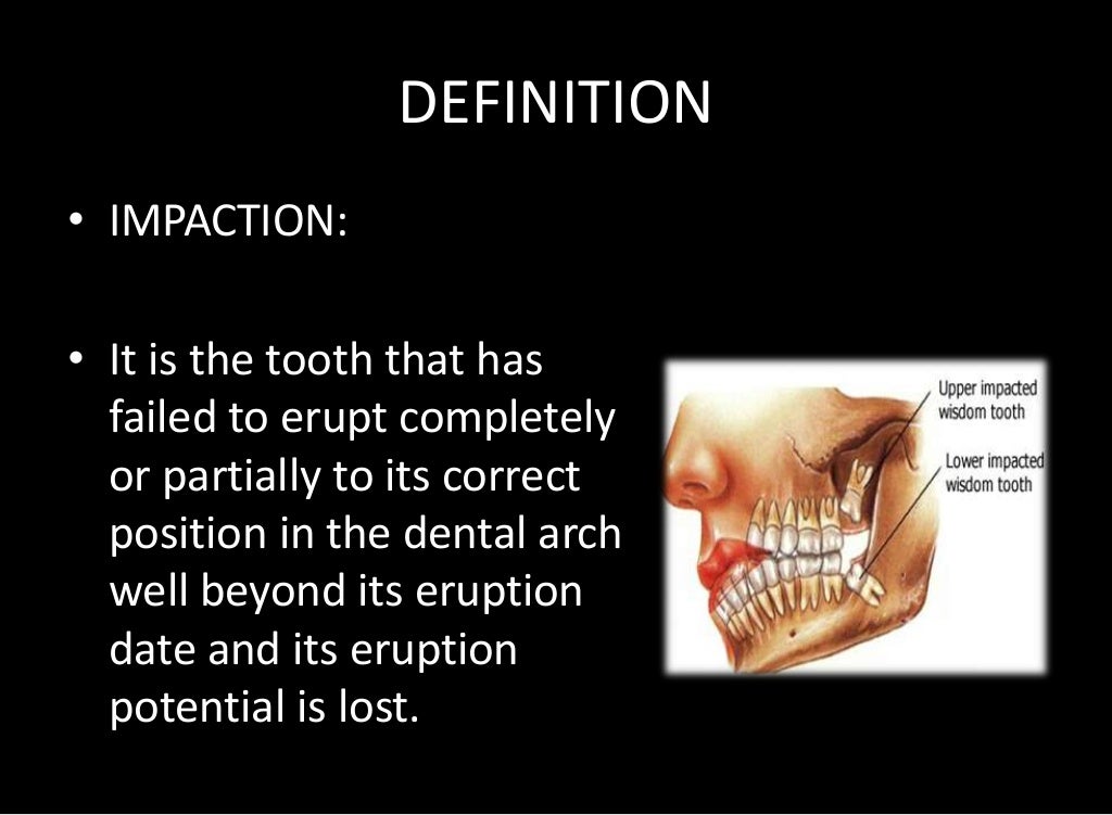 Tooth impaction