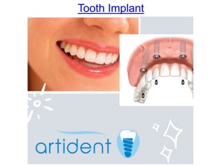 Tooth Implant
 