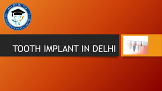 TOOTH IMPLANT IN DELHI
 