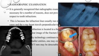 • RADIOGRAPHIC EXAMINATION
• It is generally recognized that radiographic examination, while obviously
necessary for a number of reasons, does not provide much information with
respect to tooth infractions.
• This is because the infraction lines usually run mesiodistally in the majority of
cases and the x-ray beam travels perpendicular to the fracture lines.
• If, however, the tooth infraction is located in a buccolingual direction, the x-ray
beam may produce a clear image of the fracture line on the film or the sensor.
• If computed tomography technology continues to improve with respect to
imaging smaller and smaller entities, one may expect that in the future,
infractions in the size of 5 mm may be detectable.
 