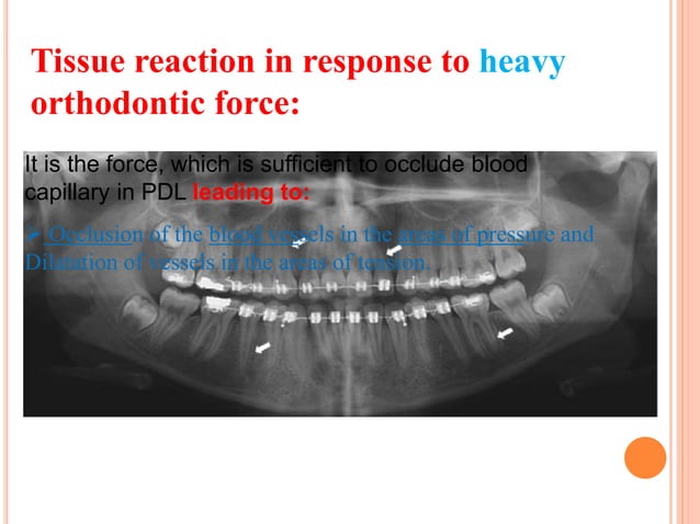 Tooth movement in orthodontics how and why | PPTX | Dental Health ...
