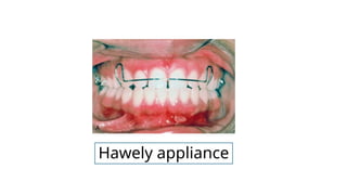Theories and types of tooth movement .pptx