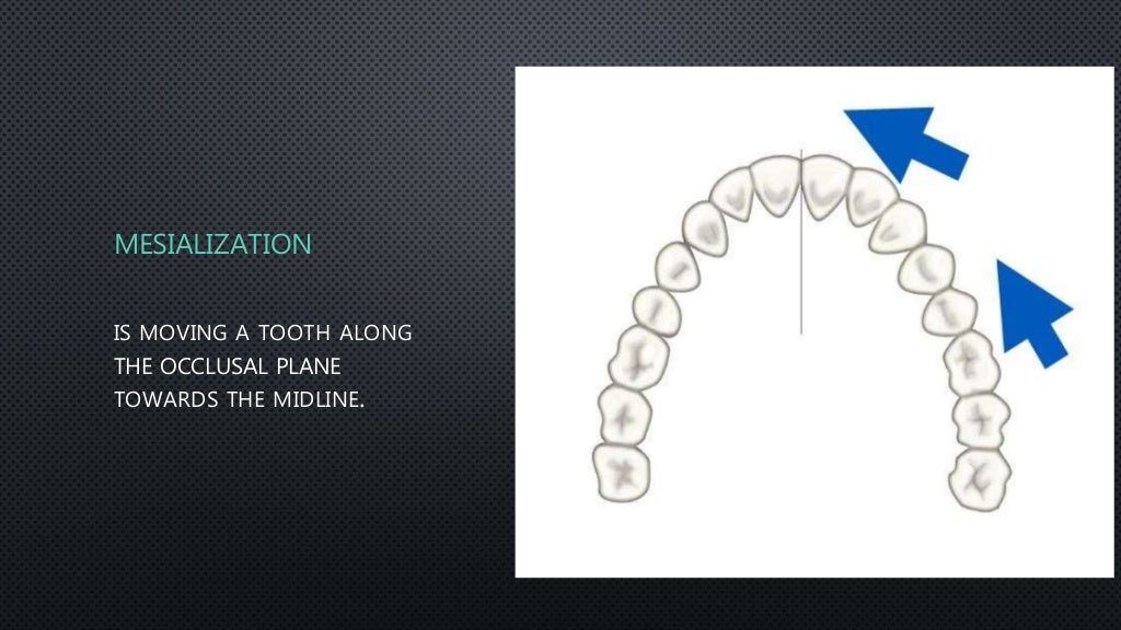 Orthodontic Tooth movement types